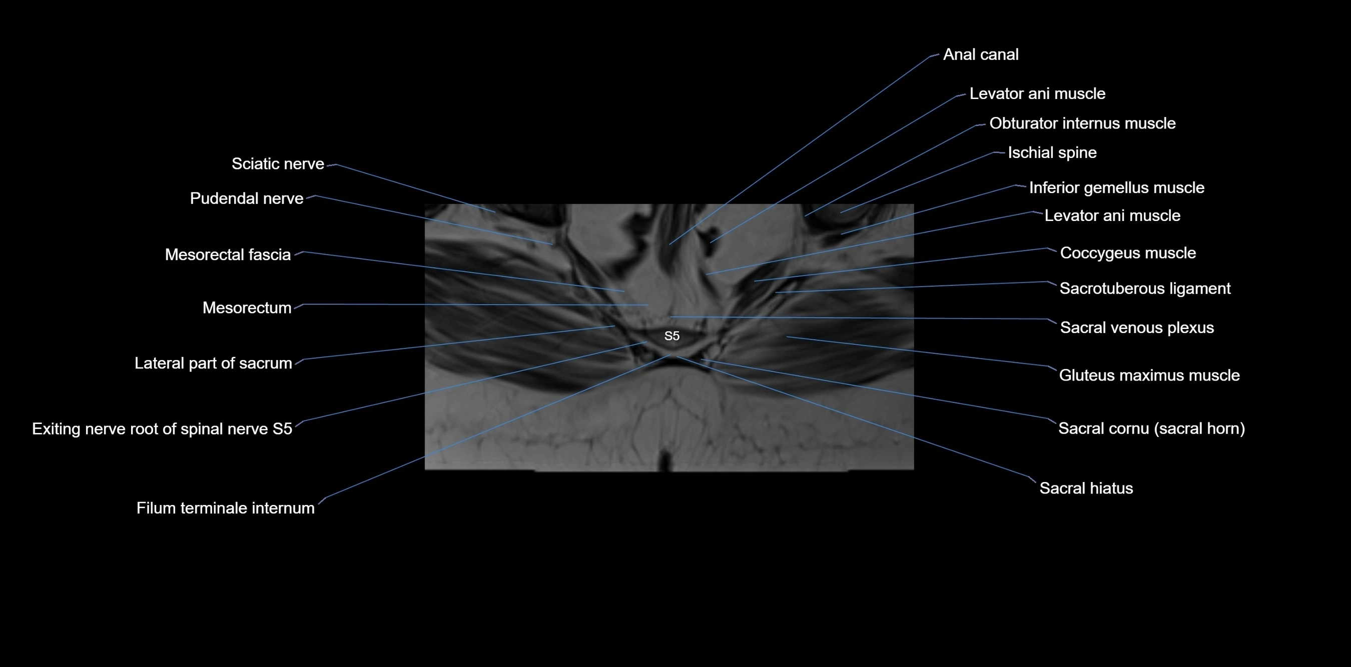 MRI sacrum, coccyx and sacroiliac joint axial cross sectional anatomy 3T  radiology  image-img-00001-00061.webp